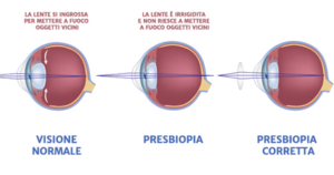 Presbiopia 3